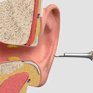 WaxClean® : le nettoyage intelligent des oreilles avec caméra HD
